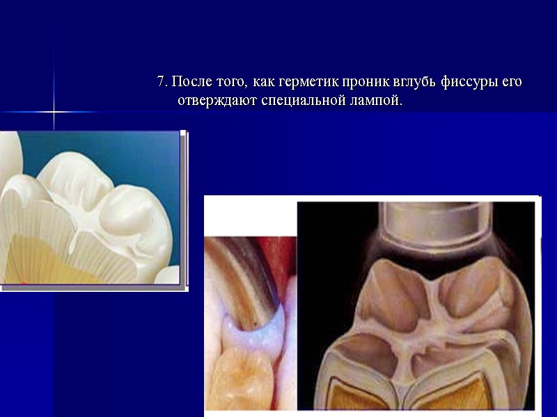 7. После того, как герметик проник вглубь фиссуры его отверждают специальной лампой.